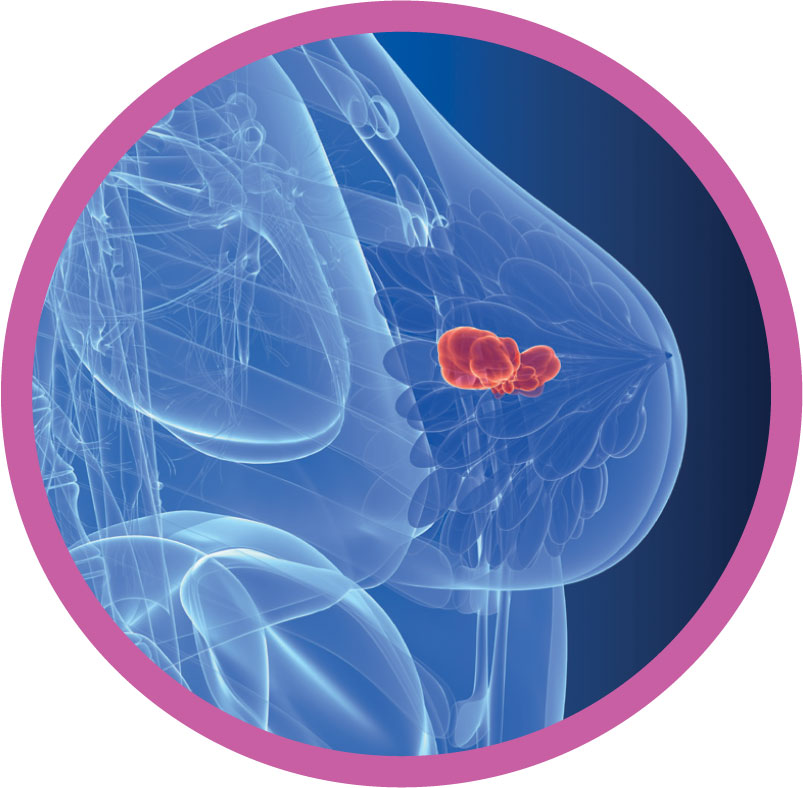 Breast cancer visual