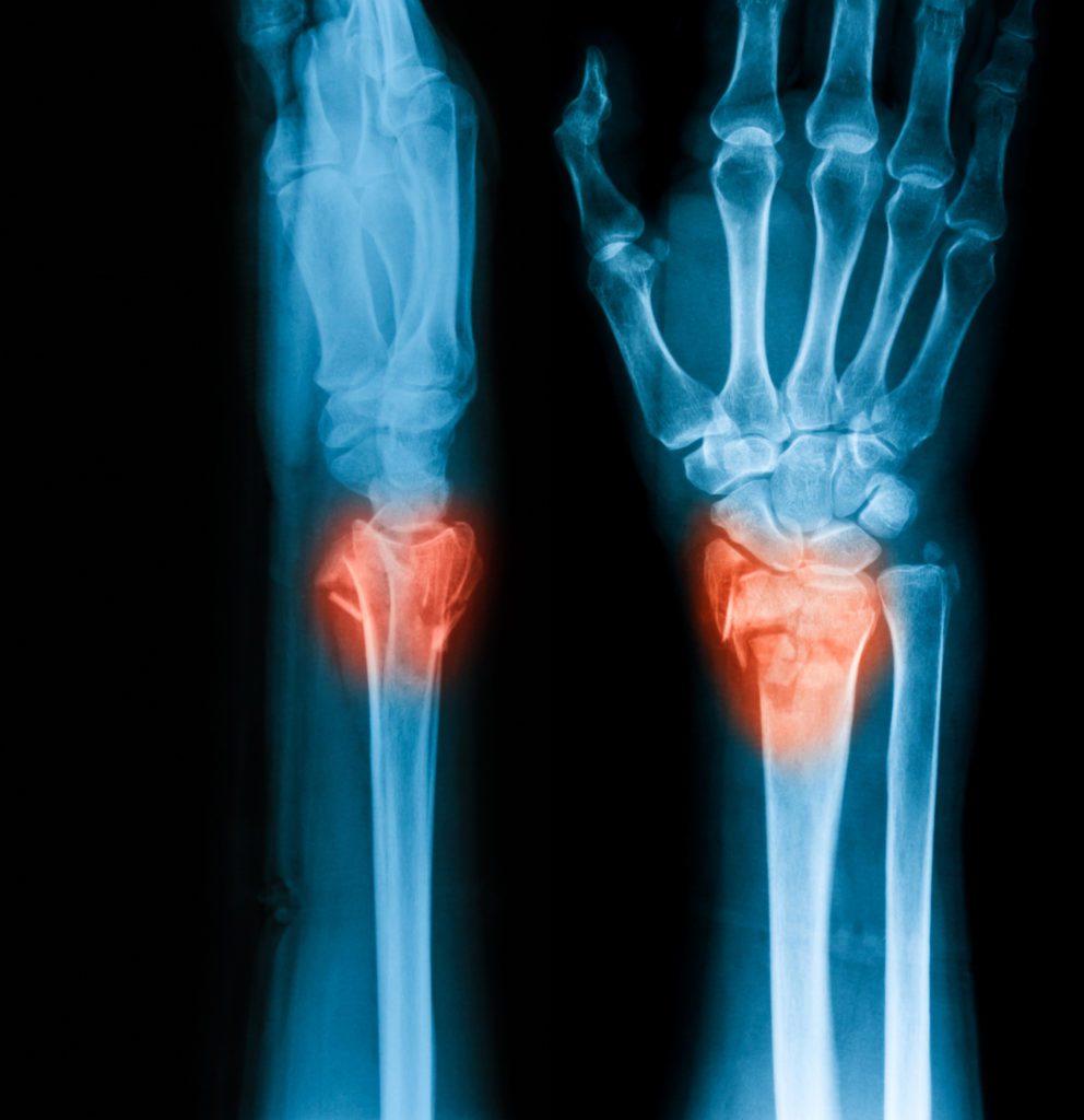 X-ray image of wrist joint, AP and lateral view. Showing distal radius fracture.