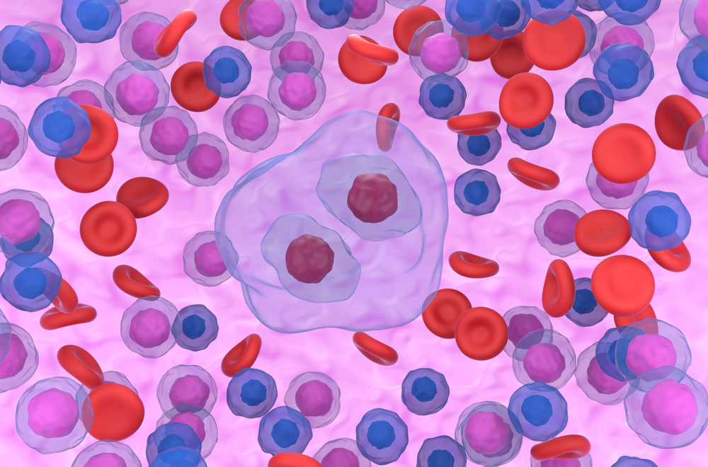 Reed-sternberg,Cell,In,Hodgkin,Lymphoma,Front,View,3d,Render,Illustration